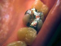 tooth with amalgam filling